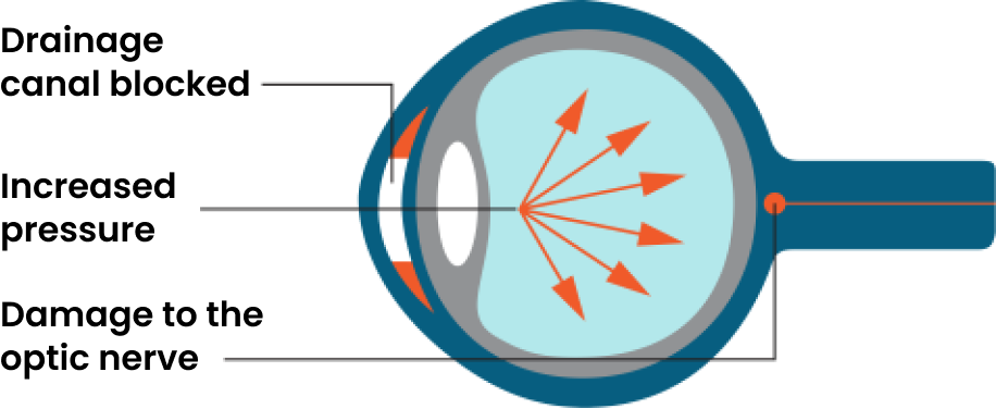 What happens to the eye with glaucoma.